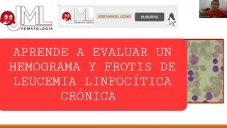 LEUCEMIA LINFOCÍTICA CRÓNICA FROTIS DE SANGRE PERIFÉRICAmedicina hematologia [upl. by Chiles]