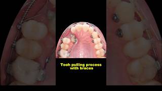 Pulling out hidden teeth when braces braces orthodontist dentist bracesoff [upl. by Rrats]