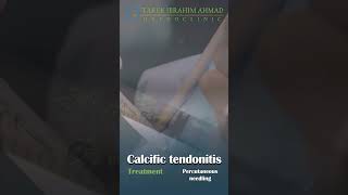 treatment of calcific tendonitis [upl. by Haines942]