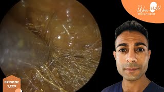 1229  Complicated amp Challenging Matted Ear Wax Removal [upl. by Chelsea]