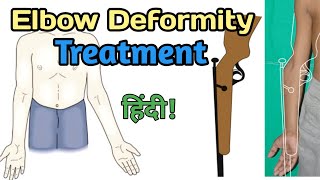 elbow deformity treatment  elbow deformity correction exercises  cubitous valgus correction [upl. by Aziar327]