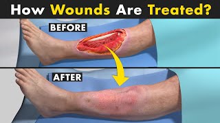 Wound Debridement Procedure  Unbelievable Ways Doctors Treat Wounds [upl. by Elleinod]