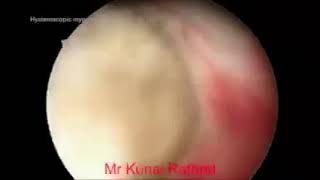 Hysteroscopic myomectomy with monopolar loop resectoscope [upl. by Anuala262]