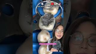 Dentist does a silver filling filling cavity silverfilling dentist [upl. by Cantone165]