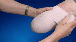 Wrapping Technique BK Residual Limb  Springer Prosthetic amp Orthotics Services [upl. by Phedra]