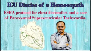 ESRA protocol for chest discomfort  Case of Paroxysmal Supraventricular Tachycardia [upl. by Endres]