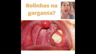 Amigdalite crônica caseum bolinhas amarelas na garganta Otorrinolaringologista em Parauapebas [upl. by Olemrac]