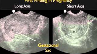 How To Intrauterine Pregnancy  Part 1 Case Study Video [upl. by Adlihtam]