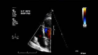 Eccentric tricuspid regurgitation jet suggests flail leaflet [upl. by Appledorf]