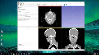 How to 3D print CT scans using democratiz3D in 4 Easy Steps [upl. by Eirahcaz]