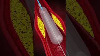 How Does Coronary Angioplasty Work  Blocked Arteries Treatment shorts  creativelearning3d [upl. by Nevile208]