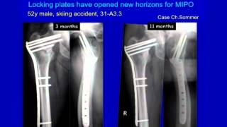 Complex Proximal Femur Fractures [upl. by Lehcer]