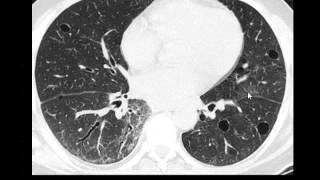 Chest x ray interpretation part 2 DR AMR SAADAWY [upl. by Naylor]