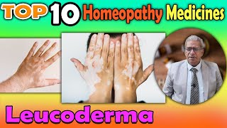 Leucoderma Causes and homeopathy Treatment  Dr P S Tiwari [upl. by Virgilia]