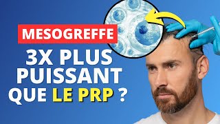 Calvitie  La Mésogreffe  Nouvelle révolution antichute  😱 [upl. by Jaye]