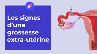 Grossesse extrautérine  les signes à connaître [upl. by Damick]