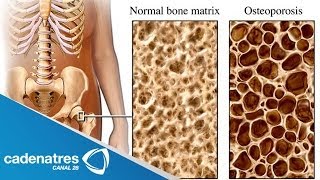 ¿Qué es la Osteoporosis  Cómo prevenir la osteoporosis [upl. by Naus]