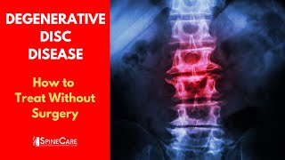 What is DEGENERATIVE DISC DISEASE  How to Treat It WITHOUT SURGERY [upl. by Lapo354]