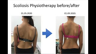 How exercises helped my scoliosis [upl. by Enom369]