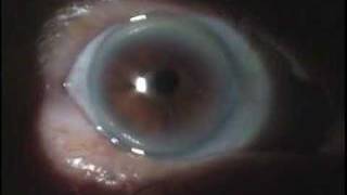 Pterygium and Arcus Senilis [upl. by Ashbaugh]