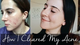 How I Cleared My Acne  Julia Giaimo [upl. by Darda]