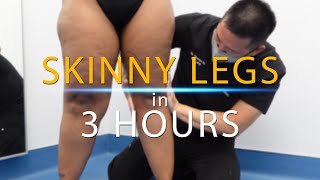 Lipo 360 Knees  Leg Liposuction  Immediate Results  Lipedema Surgery  Artlipo  Expert Dr Su [upl. by Ycart]