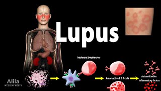 Lupus Symptoms Risk factors Pathophysiology Diagnosis and Treatments [upl. by Yllor]