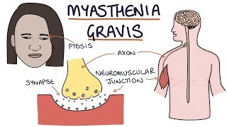 Myasthenia Gravis [upl. by Elisha68]