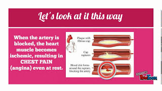 Pathophysiology of Unstable Angina [upl. by Neau]