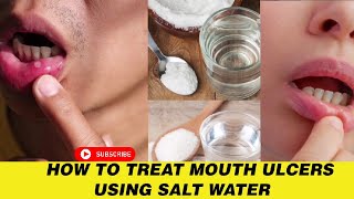 How To Treat Mouth Ulcers Using Salt Water [upl. by Gingras]