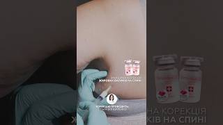 Інєкційна корекція жирових валиків на спині мезококтейлем Dermaheal LL🟠 ліполітик мезотерапія [upl. by Poucher2]