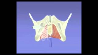 PROLAPSOS GENITAIS  Cirurgia de Prolapso com Tela Calistar [upl. by Eittod]