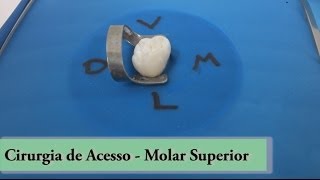 Molar Superior  Cirugia de Acesso [upl. by Acsirp]