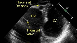 NON COAPTING TRICUSPID VALVE [upl. by Alanna574]