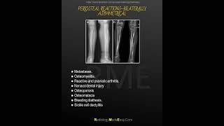 Periosteal reactions Bilaterally asymmetrical [upl. by Laamak]
