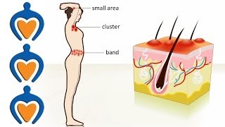 Shingles  The causes symptoms treatment and prevention [upl. by Cattan]