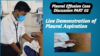 Pleural EffusionCase Discussion PART 02 Pleural Aspiration live Demonstration [upl. by Schatz]