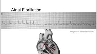 Tachycardia Basic Discussion [upl. by Gusta]