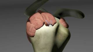 Rotator Cuff Tears [upl. by Lesh]