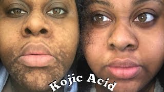 4 MONTHS KOJIC ACID EXPERIENCE \\ Sherelle Saint Rose [upl. by Eiraminot]