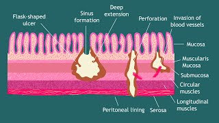 Pathogenesis of Entamoeba histolytica Notes  Parasitology  Basic Science Series [upl. by Allbee]