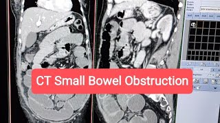 CT Imaging  Small Bowel Obstruction shorts shortsvideo [upl. by Yaron]