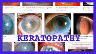 keratopathy [upl. by Lovett]