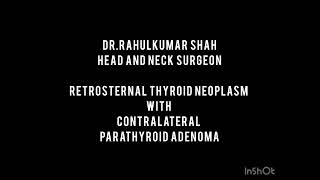 Retrosternal Thyroid Neoplasm With Contralateral Parathyroid Adenoma [upl. by Sulokcin384]