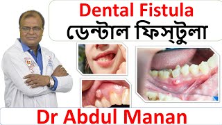 ডেন্টাল ফিস্টুলা। Dental Fistula । Best Homeopathic Doctor in Bangladesh । Dr Abdul Mannan [upl. by Broddie]