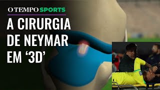 Neymar Entenda lesão e cirurgia feita pelo atacante em Belo Horizonte [upl. by Archy821]