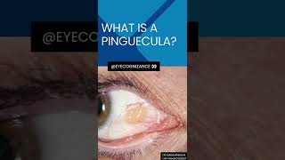 what is a pinguecula ¦eyecognizance [upl. by Aeneas965]