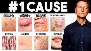 The MOST Common Deficiency in All Skin Diseases Dermatitis [upl. by Ermanno447]