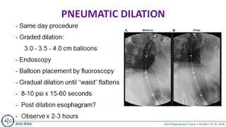 Achalasia Inject Dilate or Surgery [upl. by Ainola]