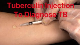 Tuberculin  How to Diagnose TB infection [upl. by Russel]